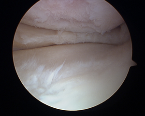 Cartilage Injury