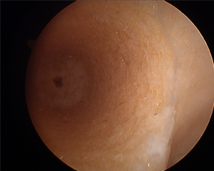 ACL Reconstruction socket for docking of the new ACL BTB graft Image