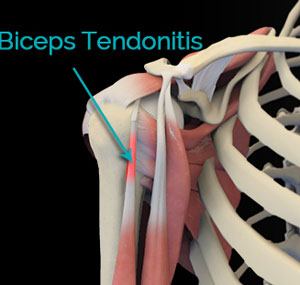 biceps tendonitis shoulder bicep tendon rupture pain bicipital