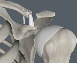 Coracoclavicular Ligament Reconstruction