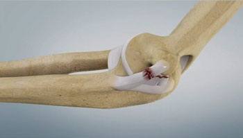 ULC Injury, Orthopedic Elbow Specialist